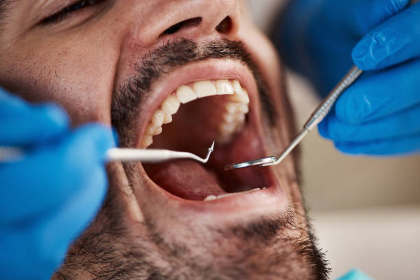 Best Emergency Treatment for Dental Infections or Abscesses in South Glens Falls, NY